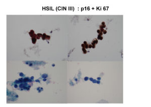 hsil-cin-iii-p16-ki-67-_1