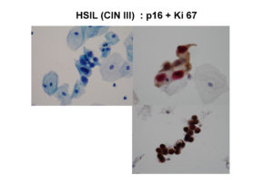 hsil-cin-iii-p16-ki-67-_2