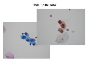 hsil-p16ki67
